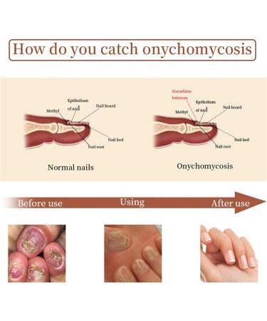 DUBUSH 7 day nail growth strengthening serum nail cuticle oil strengthener natural toenail treatment oil stronger nails in 1 week nail strengthening treatment treatment - Buy Online on GoSupps.com