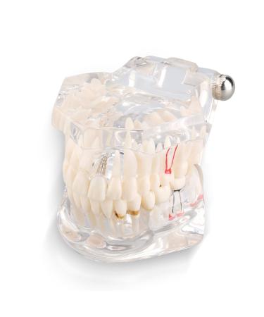 Boxwizard tooth model for dentistry students Typodont dental diseases teaching study adult typodont demonstration tooth model New tooth model