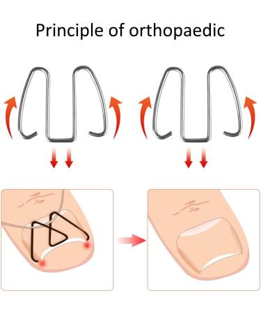 Ingrown Toenail Wire Fixer Ingrown Nail Corrector Iron Rubber Band for Pedicure Foot Care - Buy Online on GoSupps.com