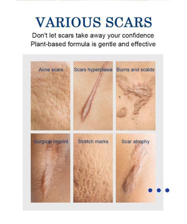 Advanced Scar Cream Gel | Medical-Grade Silicone for Keloid C-Section Acne Scars | Effective Scar Removal Treatment for Face & Body - 1 oz - Buy Online on GoSupps.com