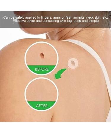 Skin Tag Cover Patch 36 Patches Skin Tag Cover Patches Mole Acne Pimple Covers Concealing Patch Sticker Pimple Cover Patch Mole Concealing Patch - Buy Online on GoSupps.com