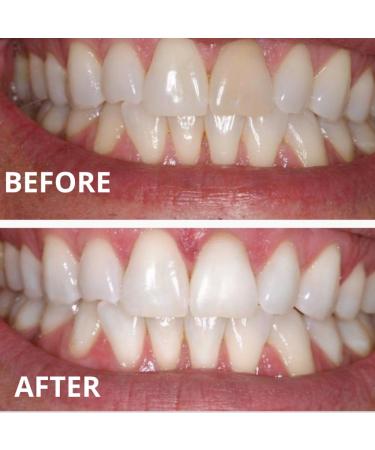 Advanced Next Gen Expertwhite Teeth Whitening Kit - Wireless Waterproof LED Light Fast Stain Removal for Sensitive Teeth - Buy Online on GoSupps.com