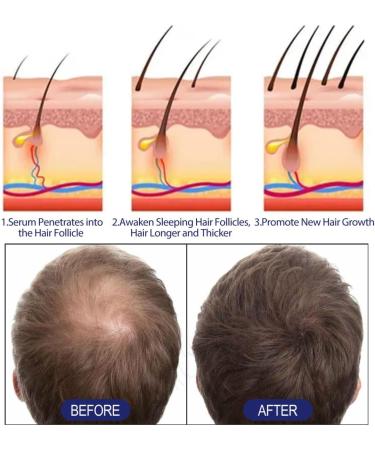 Mousse pour Les Cheveux pais des Hommes Hydrate Les follicules pileux du Cuir chevelu des Hommes Cheveux pais - Buy Online on GoSupps.com