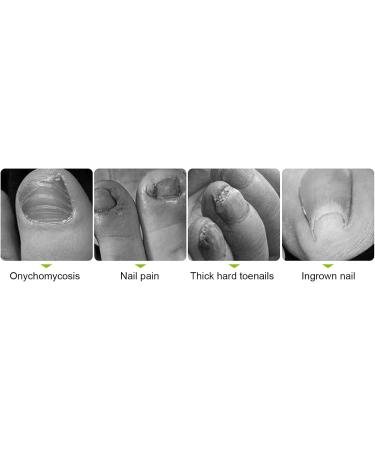 Cuticle Trimmer Nipper Toe Nail Clipper Nail Lifter Pedicure Remover Tools for Ingrown Toenail (streamer silver) - Buy Online on GoSupps.com