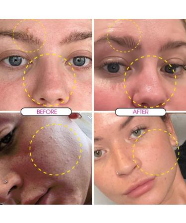 Clear Skin Days 5% Retinol Recovery Face Serum - With Niacinamide - Treats Scarring Hyperpigmentation Fine Lines & Wrinkles - Brightens Skin & Increases Cell Turnover 30ml - Buy Online on GoSupps.com