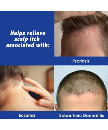 Scalpicin Max Strength Scalp Itch Treatment - 1.5 oz (Pack of 2) | Fast Shipping Worldwide - Buy Online on GoSupps.com