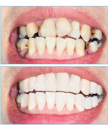 XZLZMD Silica Fake Top Bottom Dentures Instant Repair Cracked or Missing Dentures A Perfect Smile Natural Denture Reusable Teeth - Buy Online on GoSupps.com