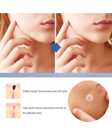 Skin T-ag Remover Patches Mole Wart Removing Sticker Natural Ingredients 144PCS QINQUAN - Buy Online on GoSupps.com