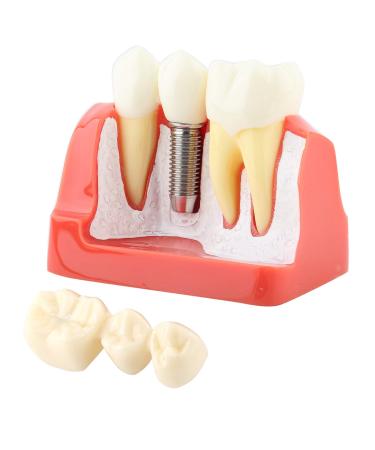 Implant Model Resin Dental Demonstration Demonstration Tooth Model Teeth Model Science Homework for Teaching Model School Dentist