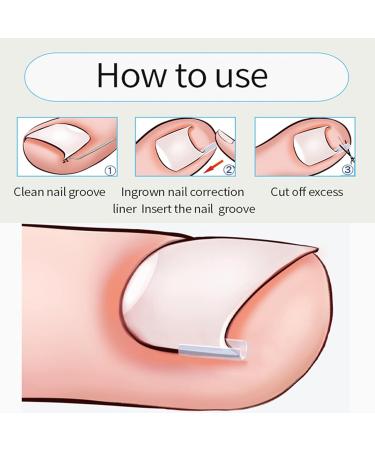 Ingrown Toenail Correction Strips Brace Kit Ingrown Toenail Corrector Toenail Correction Patches Toenail Straightener Strips for Women Men Foot Care (LIZEALUCKYWlBMWtlW-12) LIZEALUCKYsg6gvqa9uo-12 - Buy Online on GoSupps.com