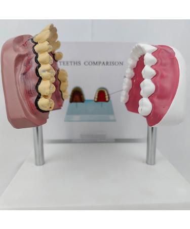 Upikit Dental Model for Sick Teeth - Compare Smoking vs Normal Teeth | Ideal for Medical Demonstrations - Buy Online on GoSupps.com