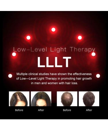Hair Growth System for Men & Women - FDA-Cleared Hair Loss Treatment for Thinning Hair - Restore Thickness, Volume, and Density - Androgenetic Alopecia Solution - Buy Online on GoSupps.com