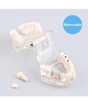 Boxwizard Tooth Model for Dentistry Students | Typodont Dental Diseases Teaching Aid - Adult Demonstration Tooth Model - Buy Online on GoSupps.com