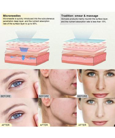 PELCAS Electric Cordless Microneedling Pen | 24 Replacement Cartridges | Adjustable 0.25mm Microneedle Dermapen for Home Use - Buy Online on GoSupps.com