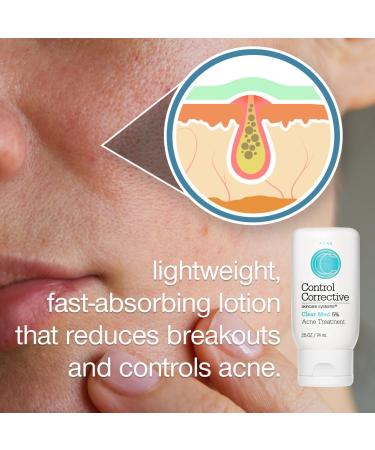 CONTROL CORRECTIVE Clear Med 5% Acne Treatment Lotion 2.5 Oz - Helps Clear & Control Breakouts Benzoyl Peroxide To Improve Efficacy And Dry Up Blemishes For Acne-Prone Skin - Buy Online on GoSupps.com