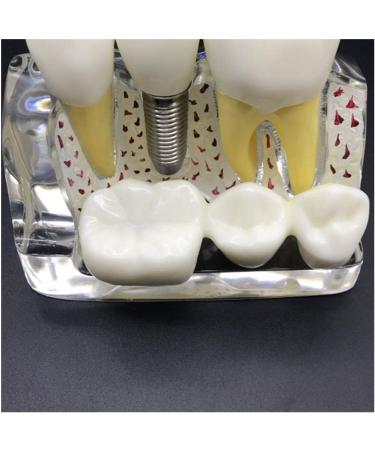 4x Enlarged Teeth Model for Dental Education | Implant & Crown Simulation | Ideal for Teaching & Demonstration - Buy Online on GoSupps.com