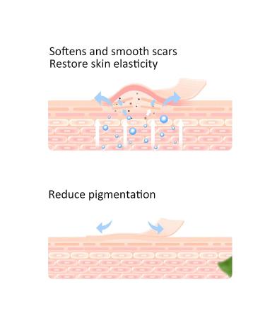 Portable Waterproof Silicone Scar Sheets - 4pcs | Scar Removal Treatment | Breathable & Reusable | Stomach Pads for Men & Women - Buy Online on GoSupps.com