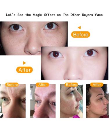 High Frequency Portable Skin Therapy Device with 6 Argon Rods - Acne Treatment Skin Tightening & Wrinkle Reduction - Buy Online on GoSupps.com