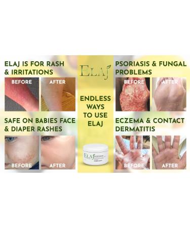 ELAJ All Natural Eczema Skin Care Moisturizing Lotion Cream - 2oz - Buy Online on GoSupps.com