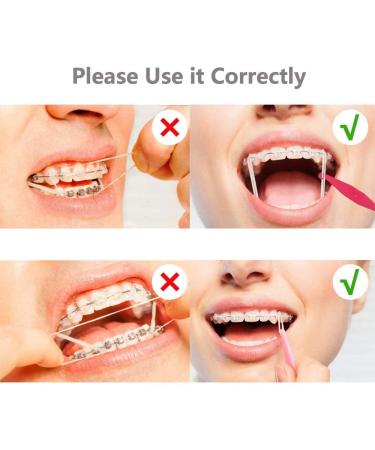 SmileTech Dental Teeth Gap 6.5 OZ Heavy Neon 3/16 Dental Teeth Bands Dental Teeth Straightener Rubber Bands100 Pcs/Bag (5 Bags) - Buy Online on GoSupps.com