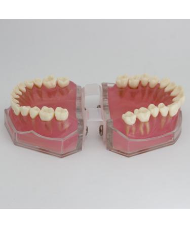 Dental Implant Teeth Model - Standard Study and Teaching Tool with Removable Teeth - Buy Online on GoSupps.com