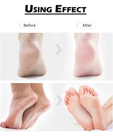 Amope Pedi Perfect Callus Remover Refills - Shell Powder Formula - 1 Extra & 4 Regular Replacements - Buy Online on GoSupps.com
