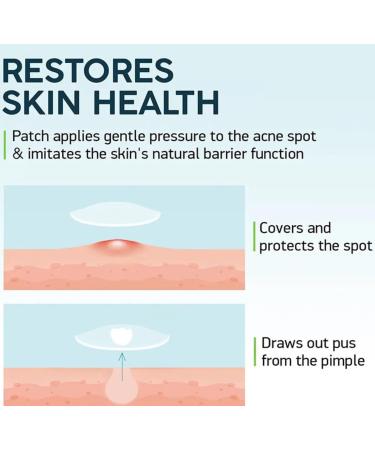 Invisible Pimple Patches with Tea Tree Oil - Hydrocolloid Acne Treatment for Quick Healing - 36ct in 2 Sizes - Non-Drying & Skin-Blending Blemish Control - Buy Online on GoSupps.com