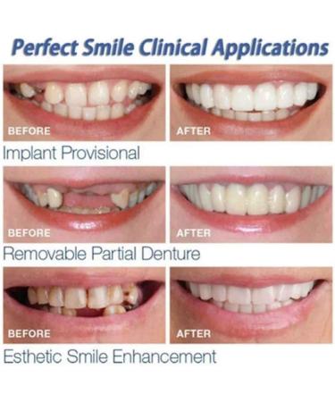 Instant Veneers Teeth - Upper & Lower Snap-On Dentures for a Confident Smile | 2 Pieces Prostheses - Buy Online on GoSupps.com