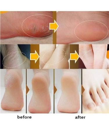 Hocossy Horse Oil Foot Cream - Very Dry Foot Cream for Moisturizing and Nourishing Feet Very Dry Foot Crevice Foot Cream 1 Piece - Buy Online on GoSupps.com