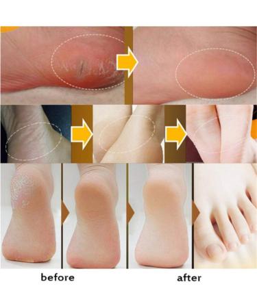 AllbestAye Foot Repair Cream - Heal Cracked Heels & Dry Feet | Moisturizing Callus Care for Soft Skin - 50g - Buy Online on GoSupps.com