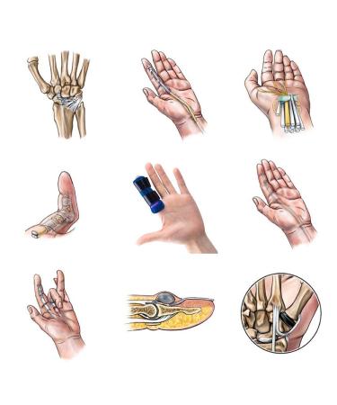 Trigger Finger Splint | Mallet Finger Brace for Pain Relief & Immobilization - Buy Online on GoSupps.com