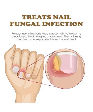Nailgrowth Deep Healing Organic Serum - Strengthening & Repair Nail Serum for Growth | 3PCs - Buy Online on GoSupps.com