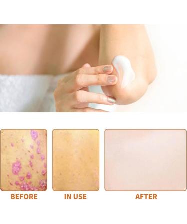 RENTANAC Bee Venom Psoriasis Cream Bee Venom Cream Psoriasis Cream New Zealand Bee Venom Cream Honey Bee Psoriasis Cream for Women Men - Buy Online on GoSupps.com