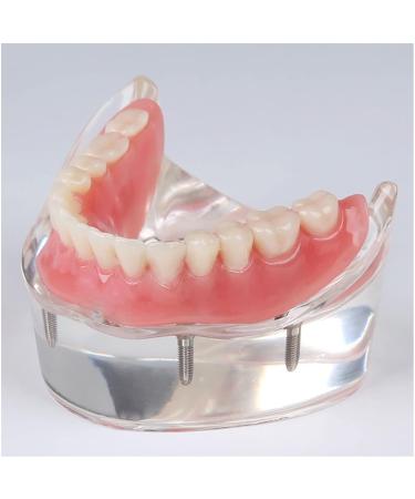 Dental Upper Implant Model - Overdenture Restoration with Transparent Teeth & Soft Gum - Ideal for Education & Study - Buy Online on GoSupps.com