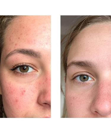 Salicylic acid toner against blackheads oily skin and large pores with 2 Salicylic acid from Australian Bodycare - Buy Online on GoSupps.com