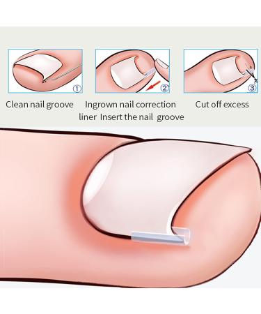 Ingrown Toenail Correction Tools Pain Relief Easy Use Ingrown Toenail Lifter Professional with Storage Box for Home for Paronychia - Buy Online on GoSupps.com