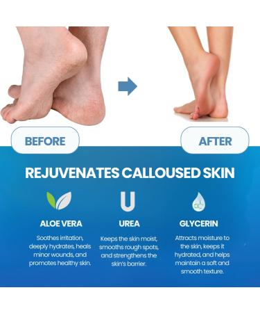 Extra Strength Callus Remover for Feet - Professional Pedicure Grade Softener for Toes Heels & Hands - Buy Online on GoSupps.com