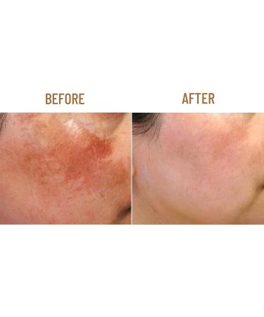 ABERA Kasumi Glowing Cream  Melasma Treatment for Face  Dark Spots Remover  Effectively Brighten Skin Tone  Hyperpigmentation Treatment  Anti-aging  Extensive Moisturizer (0.7 Oz Per Item) (1 Box) - Buy Online on GoSupps.com