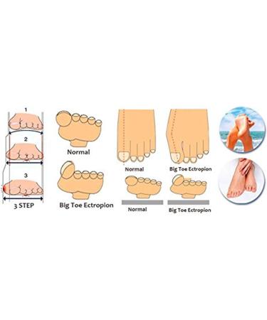 Buy Sichun Soft Silicone Gel Bunion Toe Spreader - Transparent White Foot Separator for Comfort & Correction - Buy Online on GoSupps.com
