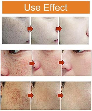  Gyiocill Anti-blemish cream freckle removal cream for face and body skincare product improves skin tone and quality suitable for all skin types - Buy Online on GoSupps.com