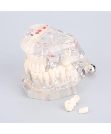 Boxwizard Tooth Model for Dentistry Students | Typodont Dental Diseases Teaching Aid - Adult Demonstration Tooth Model - Buy Online on GoSupps.com