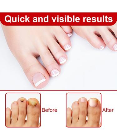 XPEX 30ml Mycose Ongles Des Pieds Strengthens and Revitalizes Nails pour Nails Damaged by Mycosis or Light Trauma pour D color s Endommag s et pais - Buy Online on GoSupps.com