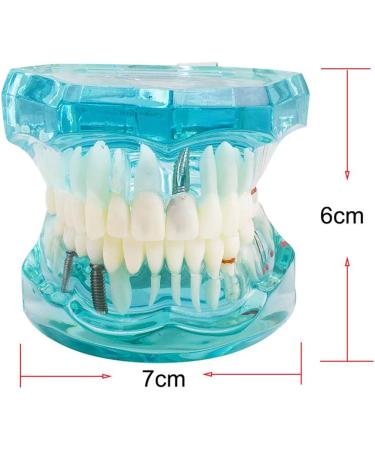 Buy Lmeil Transparent Dental Teeth Model - Ideal for Implantation & Dentist Research | Pathological Dental Model - Buy Online on GoSupps.com