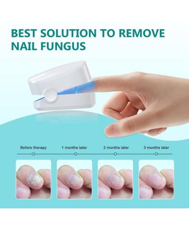 Advanced Nail Fungus Treatment Device for Thick, Discolored Nails - Nail Therapy for Healthy Toenails & Fingernails - Buy Online on GoSupps.com