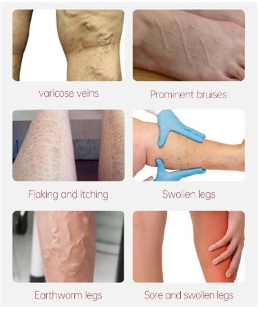 3-Pack Krampfade Cream for Legs | Varicose Veins Relief | All Skin Types | Arm & Feet Care - Buy Online on GoSupps.com