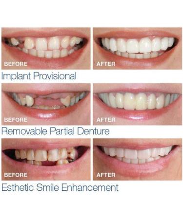 Xiaocui Provisional Dentures - 3 Pairs of Snap-On Instant Smile Teeth Veneers | Comfort Fit Flex Cosmetic Dentistry Stickers with Toothbrush | One Size Fits All - Buy Online on GoSupps.com