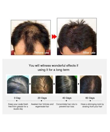 Hair Growth Essential Oil for Men & Women - Regenerate Thinning Hair & Prevent Hair Loss - Powerful Scalp Treatment Serum for Damaged Hair & Thicker Regrowth - Buy Online on GoSupps.com