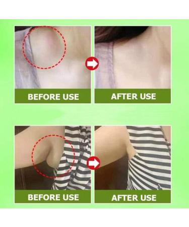 GreenHB Herbal Lymph Care Patch 10 Pcs - Neck Lymphatic Drainage Patch with Ginger Oil for Swelling & Pain Relief - Buy Online on GoSupps.com