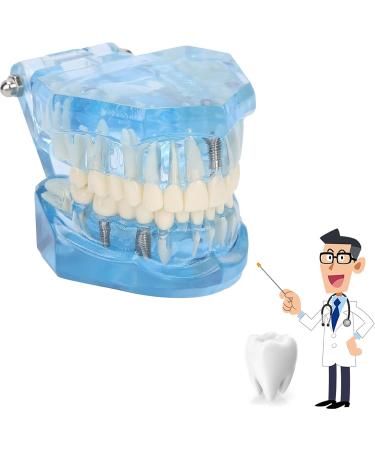 Adult Dental Implant Tooth Model - Blue-Transparent Acrylic for Pedagogical Demonstration | Removable Simulation for Dentists - Buy Online on GoSupps.com