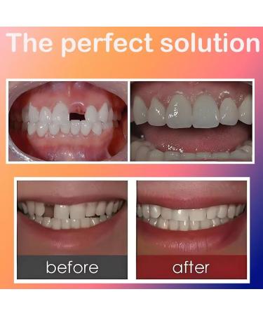 Generic Teeth Beauty Solution - Portable Upper Teeth Repair & Brightening | Reshape & Fix Broken Teeth Easily - Buy Online on GoSupps.com